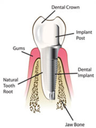 implant-diagram